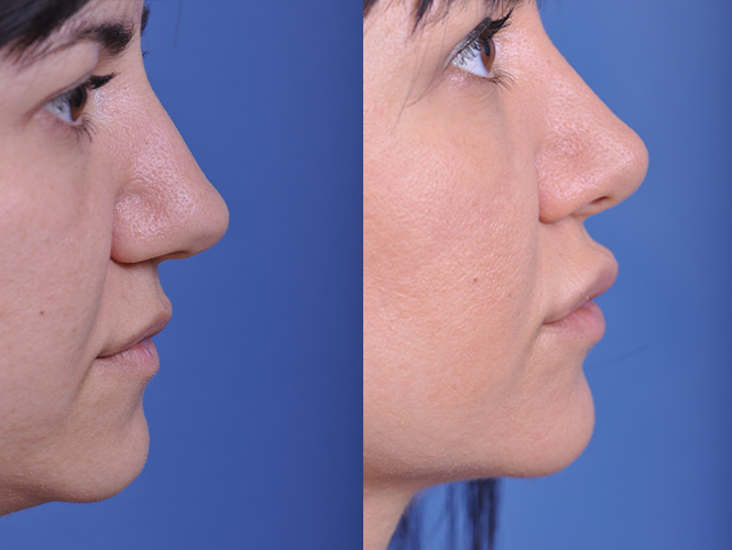 before and after rhinoplasty right side closeup view female patient case 4829