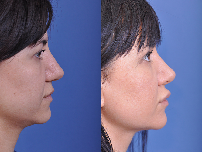 before and after rhinoplasty right side view female patient case 4829