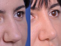 before and after rhinoplasty right angle closeup nose view female patient case 4829