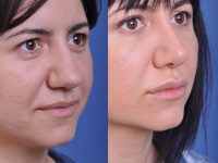 before and after rhinoplasty right angle closeup view female patient case 4829
