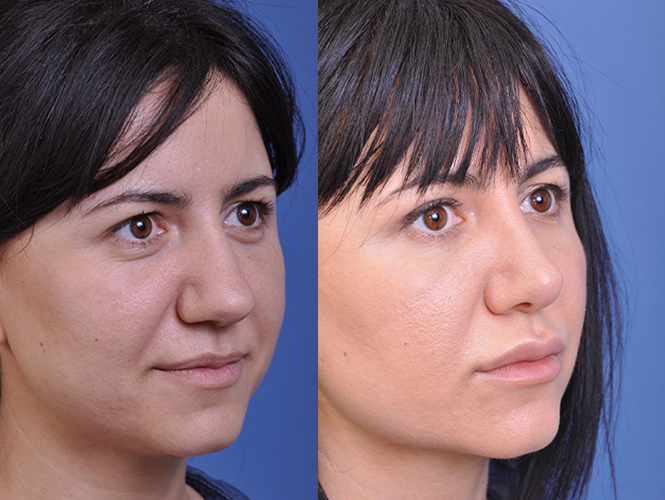 before and after rhinoplasty right angle view female patient case 4829