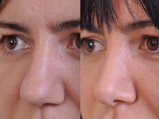 before and after rhinoplasty female patient left angle nose view case 4829