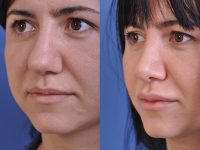 before and after rhinoplasty female patient left angle closeup view case 4829