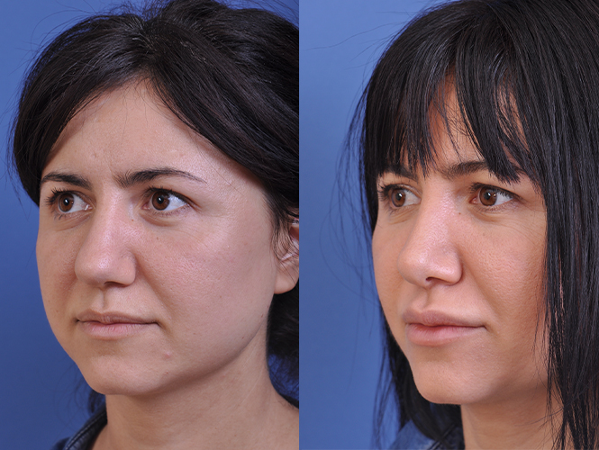 before and after rhinoplasty female patient left angle view case 4829