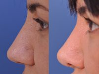 before and after rhinoplasty female patient left side nose view case 4829