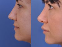 before and after rhinoplasty female patient left side closeup view case 4829
