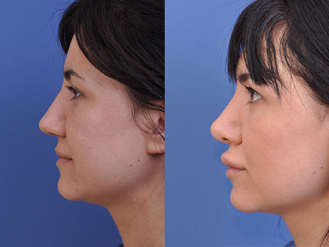 before and after rhinoplasty female patient left side view case 4829
