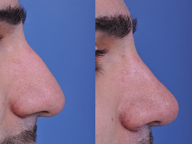 before and after rhinoplasty male patient right side nose view case 4845