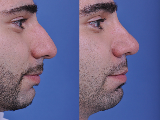 before and after rhinoplasty male patient right side closeup view case 4845