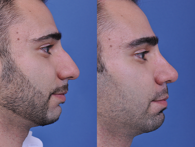 before and after rhinoplasty male patient right side view case 4845