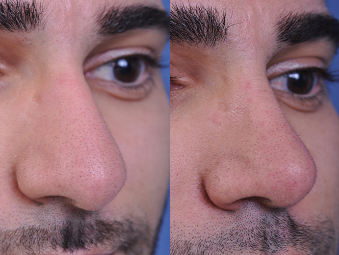 before and after rhinoplasty male patient right angle nose view case 4845