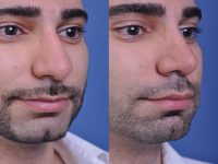 before and after rhinoplasty male patient right angle closeup view case 4845