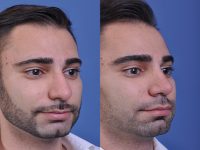 before and after rhinoplasty male patient right angle view case 4845