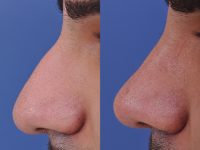 before and after rhinoplasty male patient left side nose view case 4845