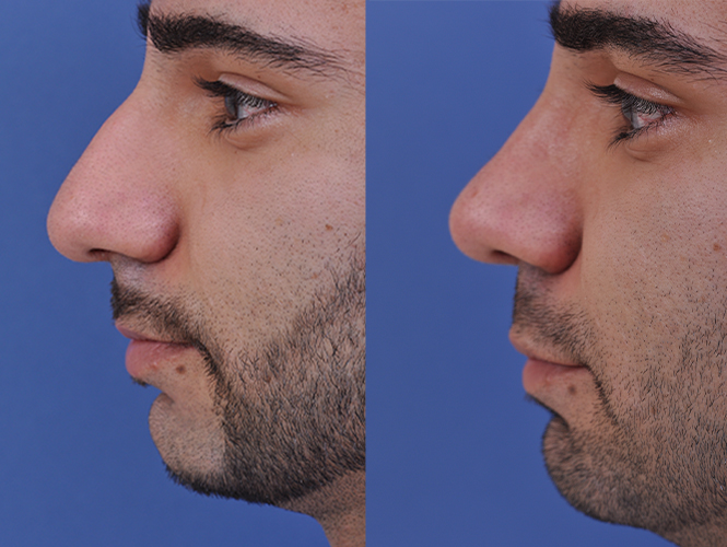 before and after rhinoplasty male patient left side closeup view case 4845