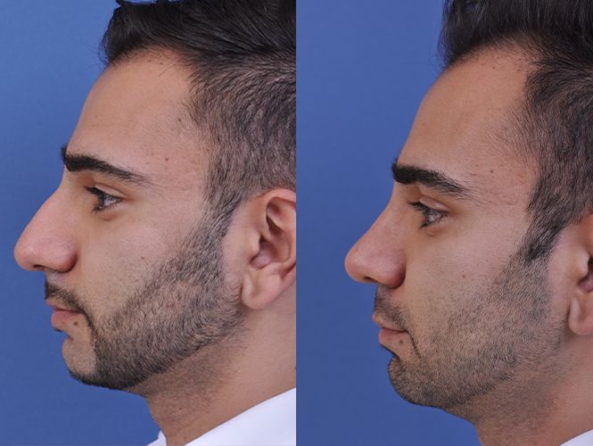 before and after rhinoplasty male patient left side view case 4845