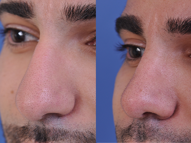 before and after rhinoplasty male patient left angle nose view case 4845