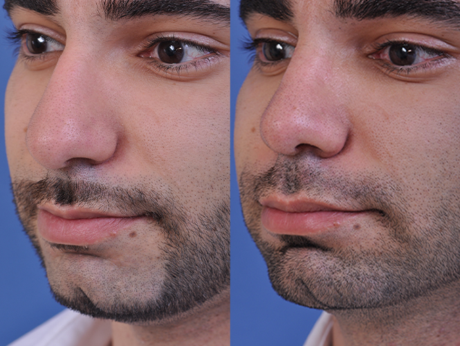 before and after rhinoplasty male patient left angle closeup view case 4845