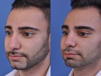 before and after rhinoplasty male patient left angle view case 4845