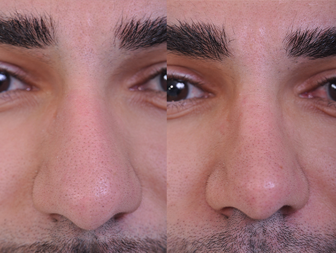 before and after rhinoplasty male patient front closeup view case 4845