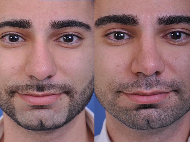 before and after rhinoplasty male patient front closeup view case 4845