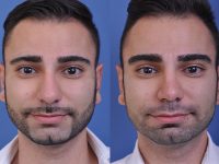 before and after rhinoplasty male patient front view case 4845
