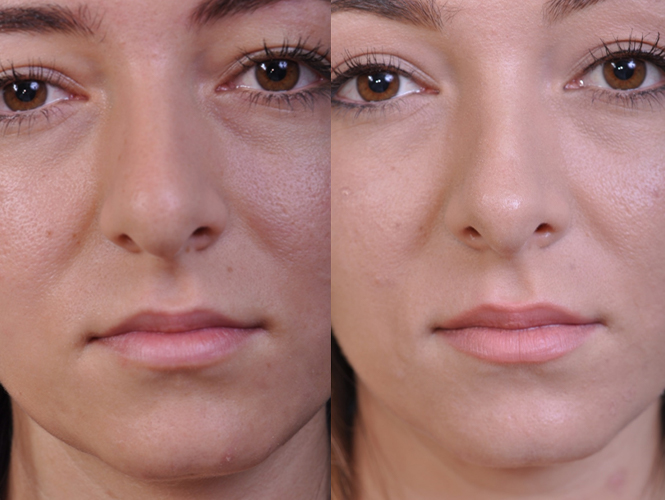 before and after rhinoplasty front view female patient case 4953