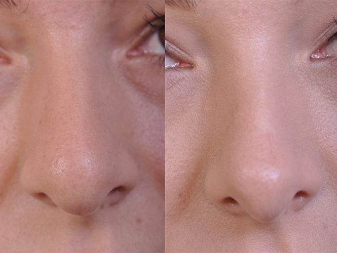 before and after rhinoplasty front closeup view female patient case 4953