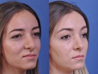 before and after rhinoplasty right angle view female patient case 4953