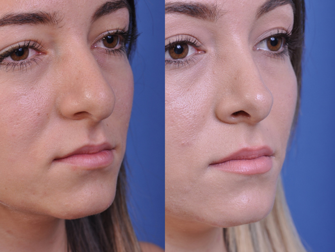 before and after rhinoplasty right angle view female patient case 4953