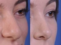 before and after rhinoplasty right angle closeup view female patient case 4953