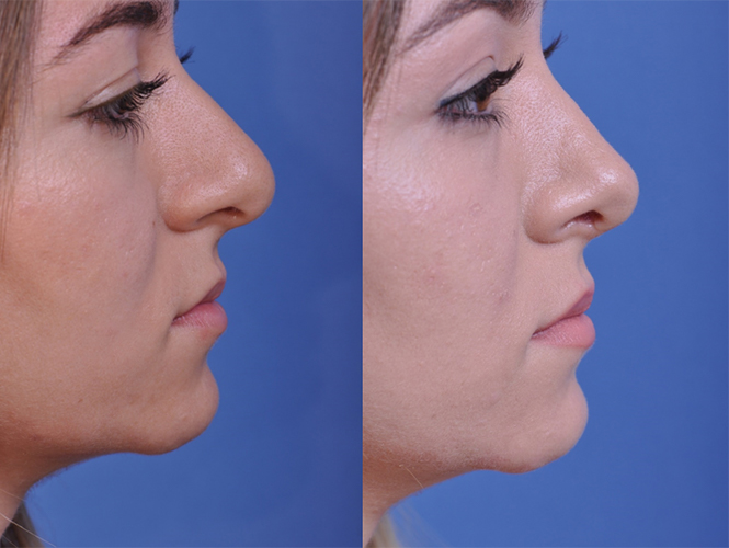 before and after rhinoplasty right side view female patient case 4953