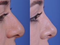 before and after rhinoplasty right side closeup view female patient case 4953