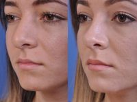 before and after rhinoplasty left angle view female patient case 4953
