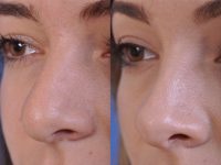 before and after rhinoplasty left angle closeup view female patient case 4953