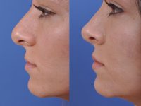 before and after rhinoplasty left side view female patient case 4953
