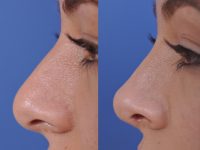 before and after rhinoplasty left side closeup view female patient case 4953