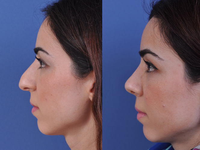 before and after rhinoplasty left side view female patient case 4968
