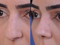 before and after rhinoplasty left angle closeup view female patient case 4968