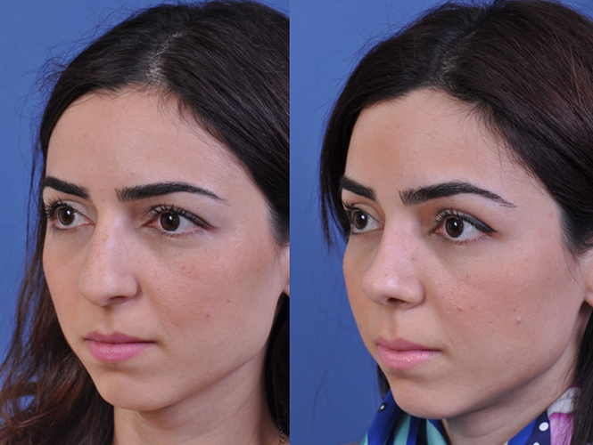 before and after rhinoplasty left angle view female patient case 4968