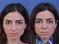 before and after rhinoplasty front view female patient case 4968