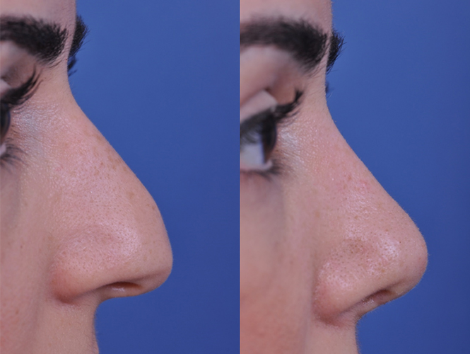 before and after rhinoplasty right side closeup view female patient case 4968