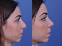 before and after rhinoplasty right side view female patient case 4968