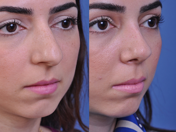 before and after rhinoplasty right angle closeup view female patient case 4968