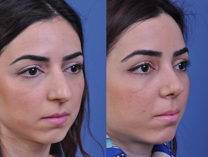 before and after rhinoplasty right angle view female patient case 4968