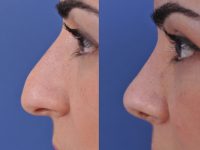before and after rhinoplasty left side closeup view female patient case 4968