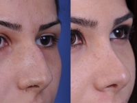 before and after rhinoplasty right angle closeup view female patient case 4978