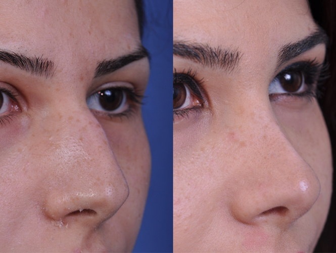 before and after rhinoplasty right angle closeup view female patient case 4978