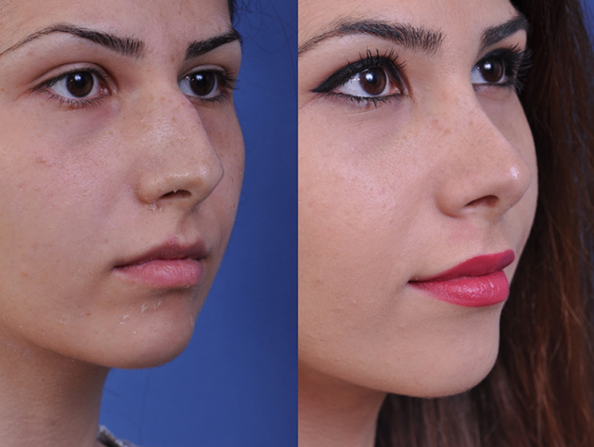 before and after rhinoplasty right angle view female patient case 4978
