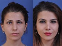before and after rhinoplasty front view female patient case 4978